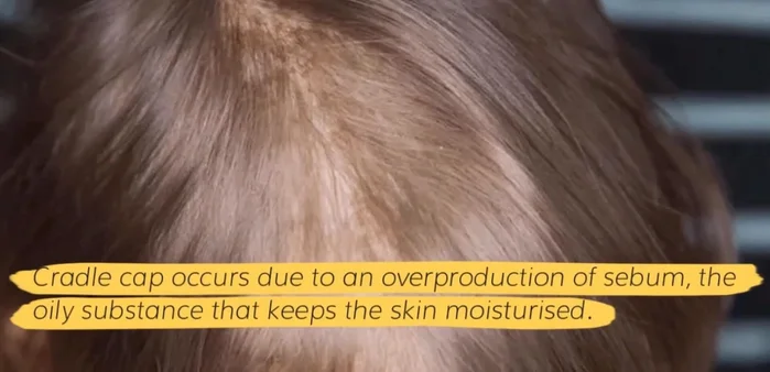 Cradle Cap Treatment: Wash and comb the scalp regularly to remove cradle cap; avoid talcum powder.