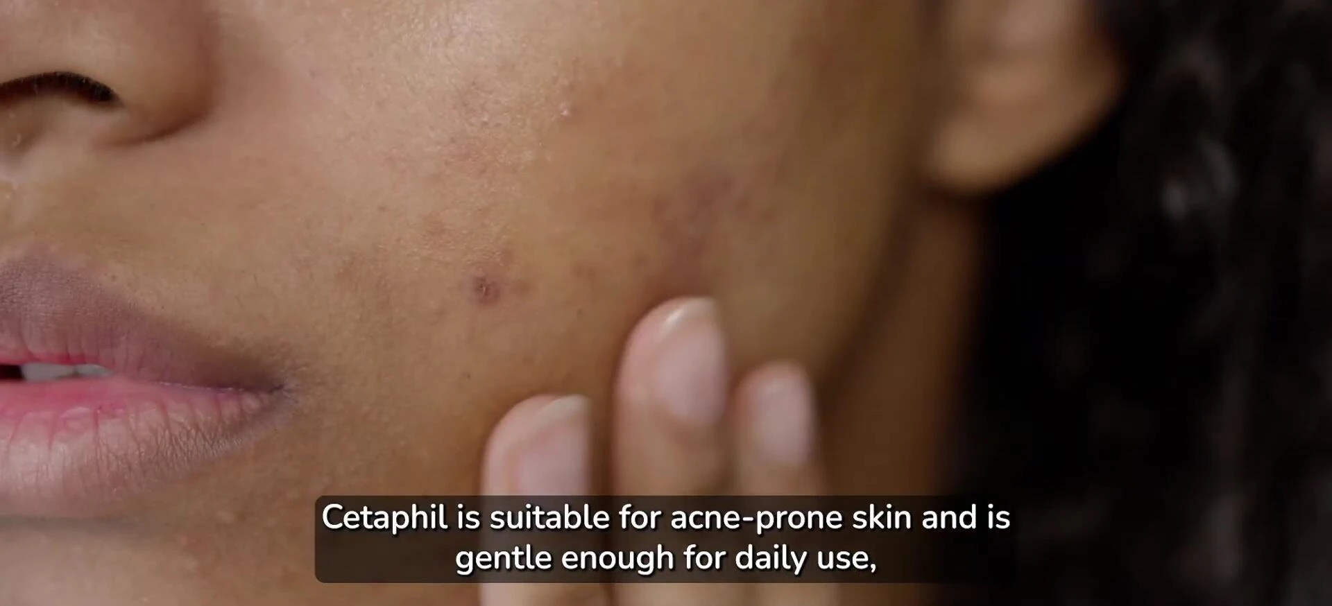 Information about Cetaphil's suitability for acne-prone skin.